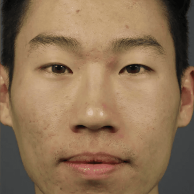 after image for acne treament