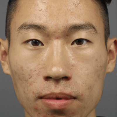 before image for acne treatment